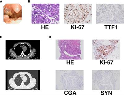 Case Report: Long-Term Survival With Anlotinib in a Patient With Advanced Undifferentiated Large-Cell Lung Cancer and Rare Tonsillar Metastasis